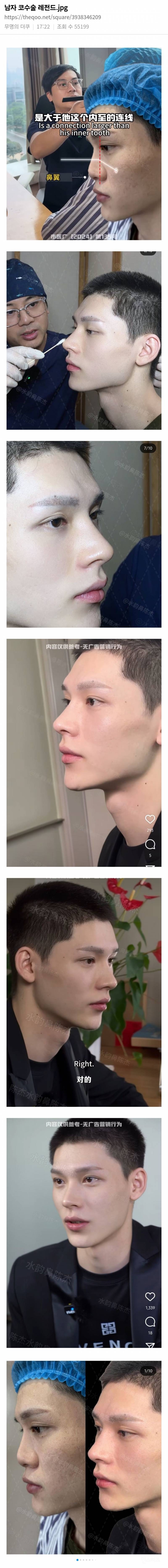 남자 코수술 레전드 | 인스티즈