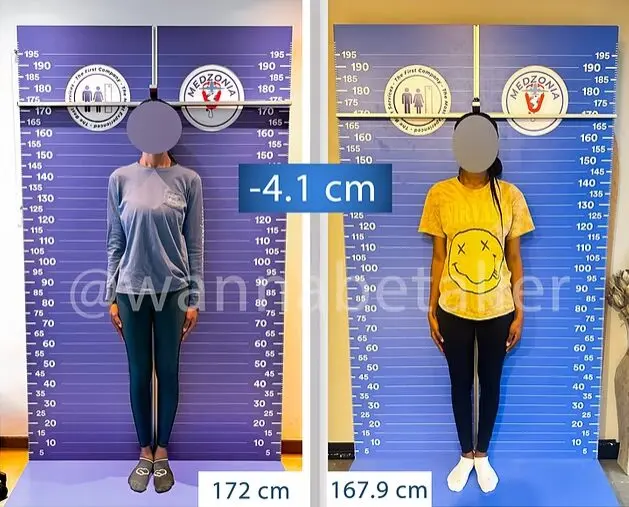 오싹오싹한 키 큰 여자들이 하는 키축소수술 | 인스티즈
