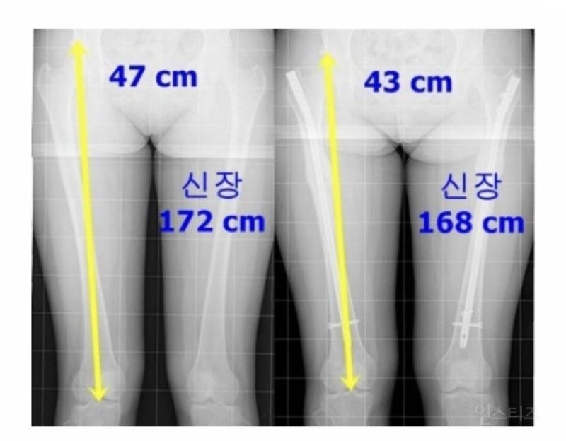 오싹오싹한 키 큰 여자들이 하는 키축소수술 | 인스티즈
