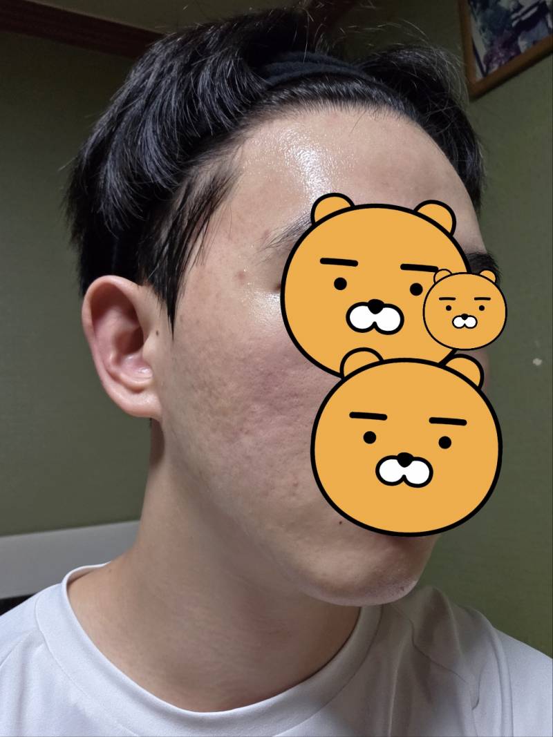 [잡담] 피부사진 첨부) 남익 여드름 자국때문에 스트레스인데... | 인스티즈