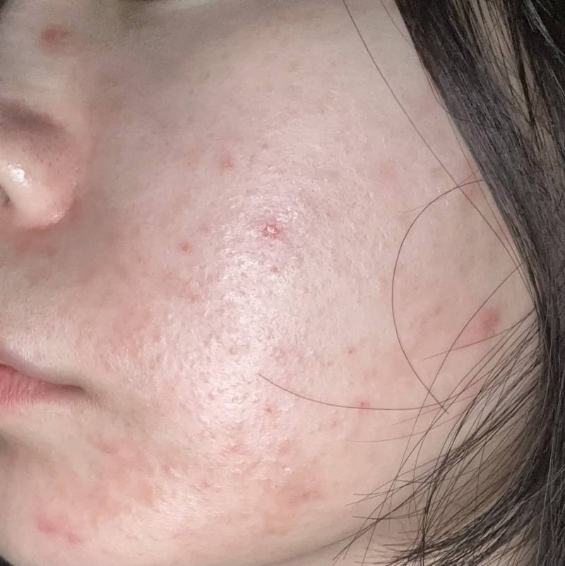 [잡담] 아 피부 너무 스트레스야ㅠㅠ | 인스티즈