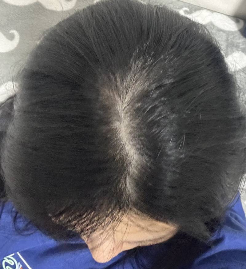 [잡담] 혹시 나 탈모일까? | 인스티즈