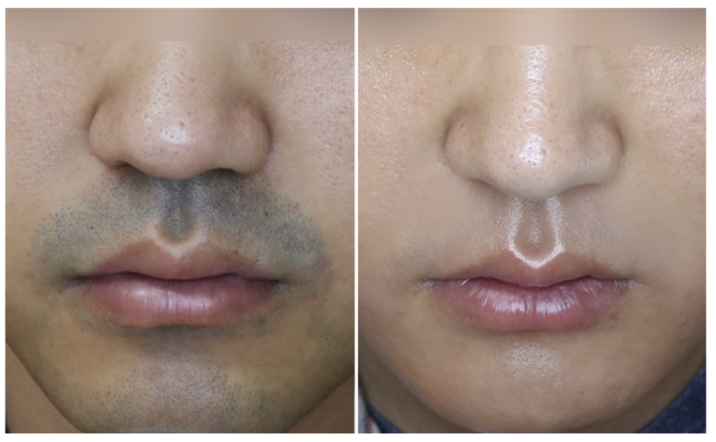 요즘 젠지남들이 겁나 한다는 시술 원탑..JPG | 인스티즈