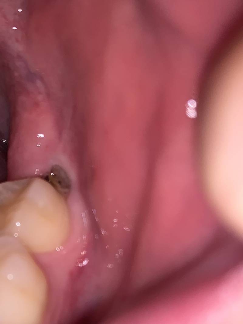 [잡담] 이거 사랑니 나는건가...? | 인스티즈