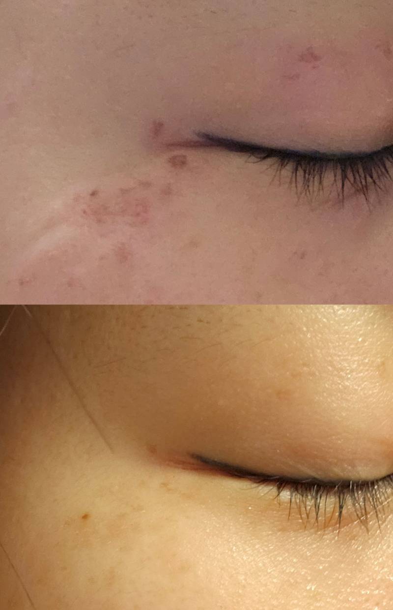 [잡담] 잡티+기미 제거 피코토닝 1회차인데 미쳤다 | 인스티즈