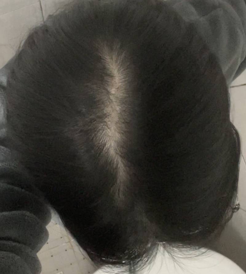 [잡담] 나 정수리 탈모 맞지? | 인스티즈