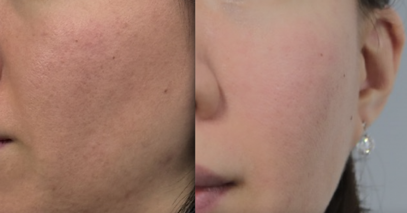 [잡담] 쥬베룩 손주사로 1년 맞다가 기계로 갈아탔는데.. | 인스티즈