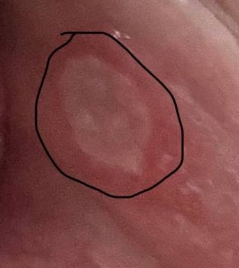 [잡담] 익들아 나 입술 안쪽에 구내염 생겼는데 개큼 ㅠ | 인스티즈
