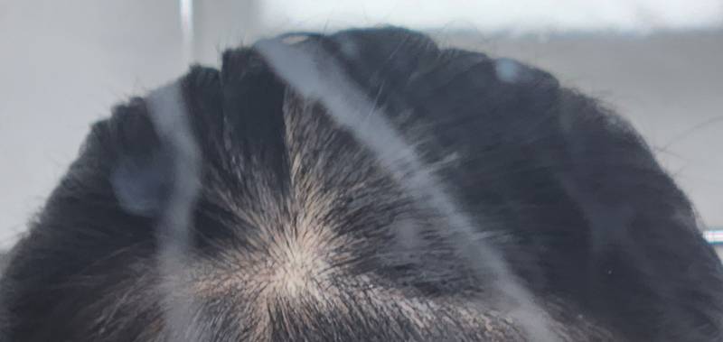 [잡담] 탈모같아보여? | 인스티즈