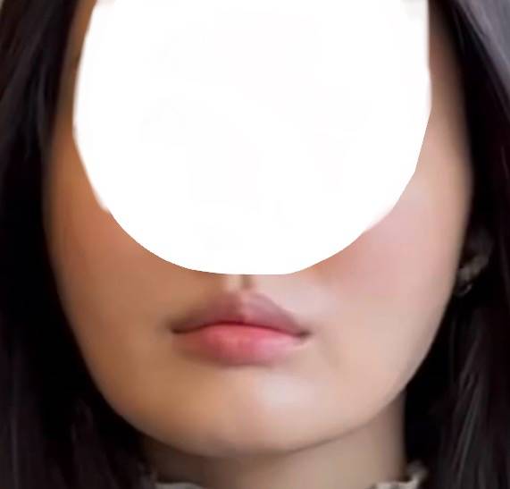 [잡담] U자 얼굴인데 사각턱 보톡스 맞으면 효과 있을까 | 인스티즈