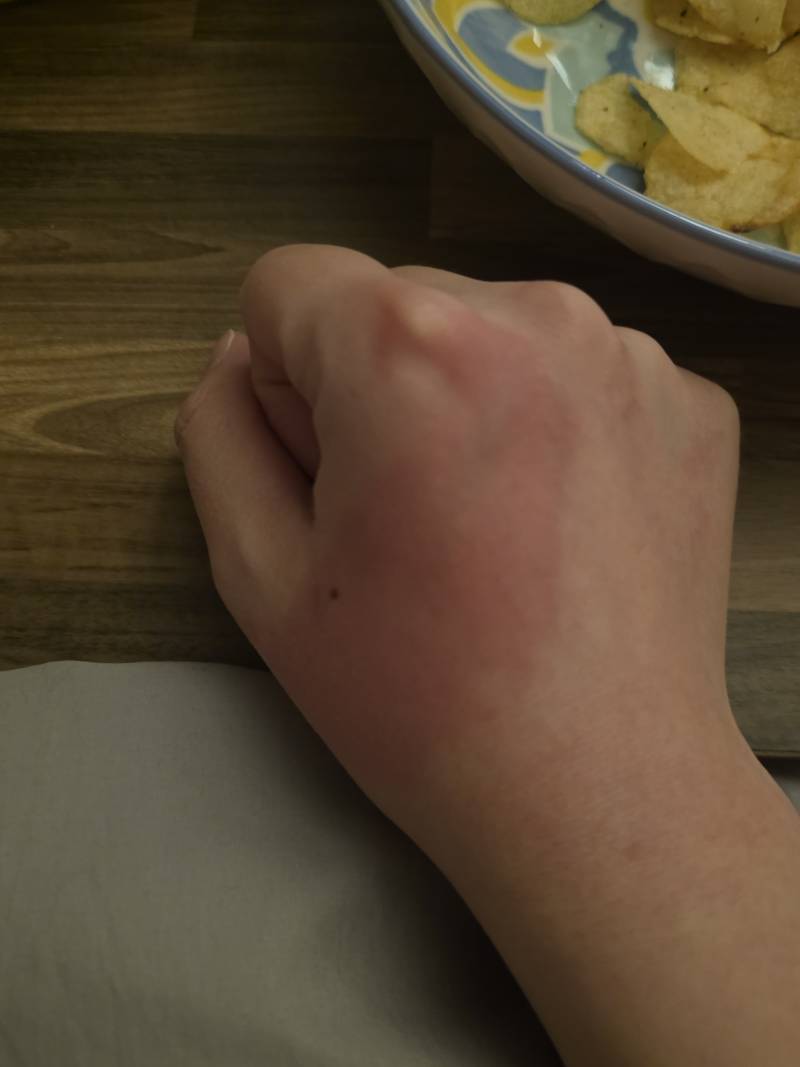 [잡담] 알코올 알러지 | 인스티즈