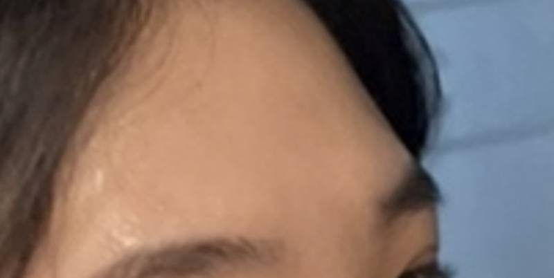 [잡담] 이마필러맞을까 ㅠㅠㅠ | 인스티즈