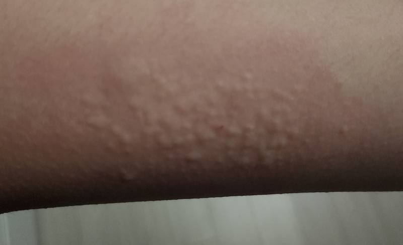 [잡담] 팔 간지러워서 긁었는데 이렇게됨 (ㅎㅇㅈㅇ | 인스티즈