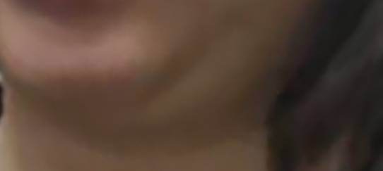 [잡담] 시술 잘알 있어?? 이런 이중턱 어떻게 없애ㅠ? | 인스티즈