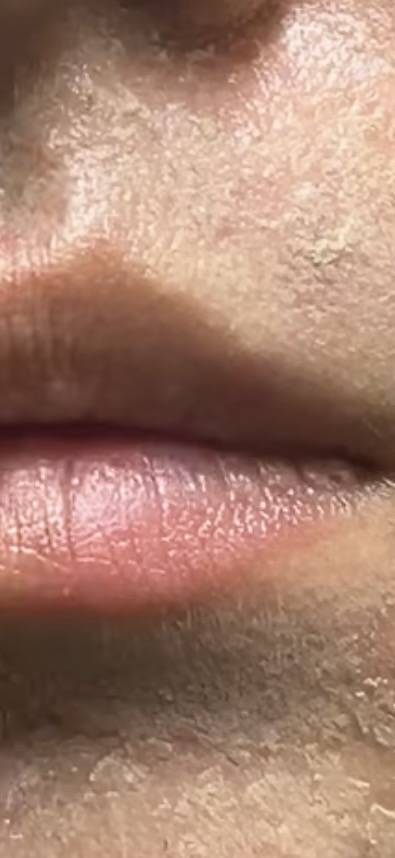 [잡담] 사진주의) 이소티논 먹는 친구들 없니? 먹은지 일주일짼데 피부화장하면 이렇게 되거든? | 인스티즈