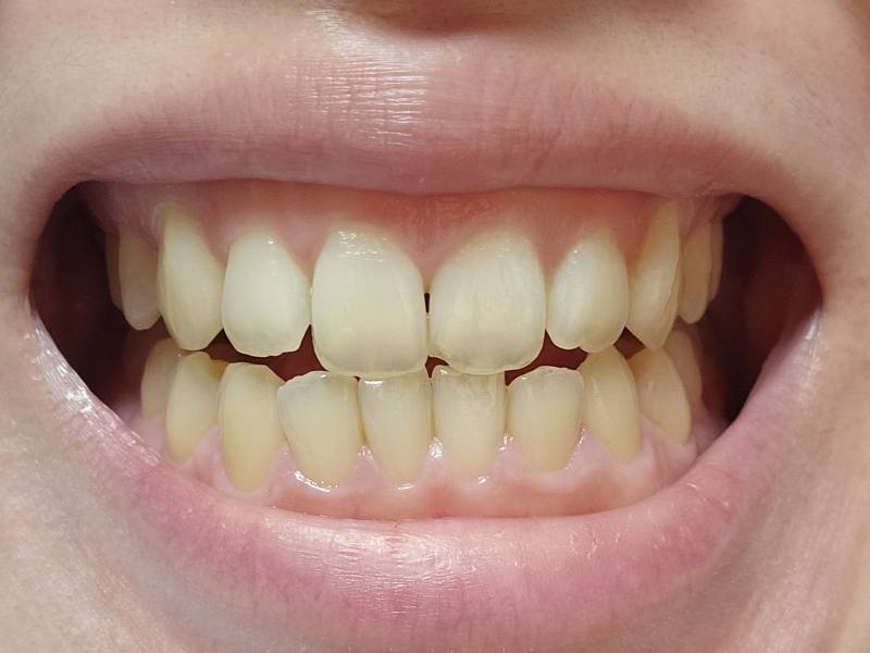 [잡담] 누렁니 익들아 나 이 많이누런편이지?ㅠㅠ혹시몰라 ㅎㅇㅈㅇ | 인스티즈