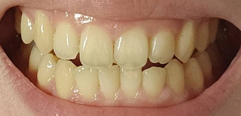 [잡담] 누렁니 익들아 나 이 많이누런편이지?ㅠㅠ혹시몰라 ㅎㅇㅈㅇ | 인스티즈