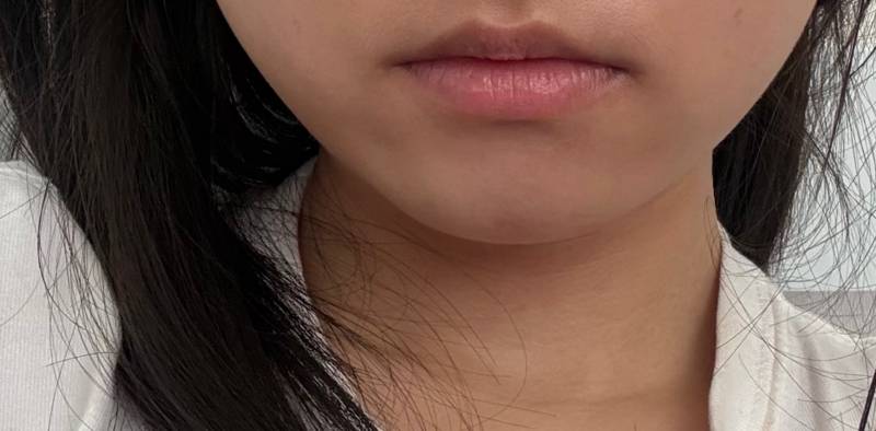 [잡담] 입술필러 해도 괜찮을까..? | 인스티즈