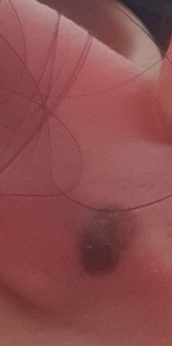 [잡담] 귀 뒤에 이런게 낫는데 이거뭐야? | 인스티즈