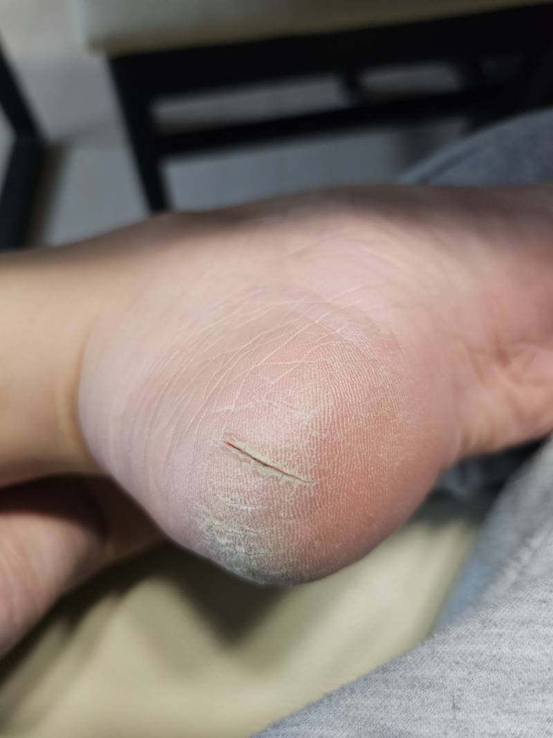 [잡담] 약혐주의) 내 뒷꿈치 각질 상태... | 인스티즈
