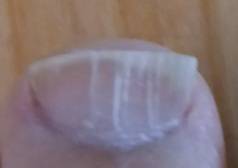 [잡담] 발톱에 하얀 선이 있는데 이거 뭘까(혐오주의) | 인스티즈