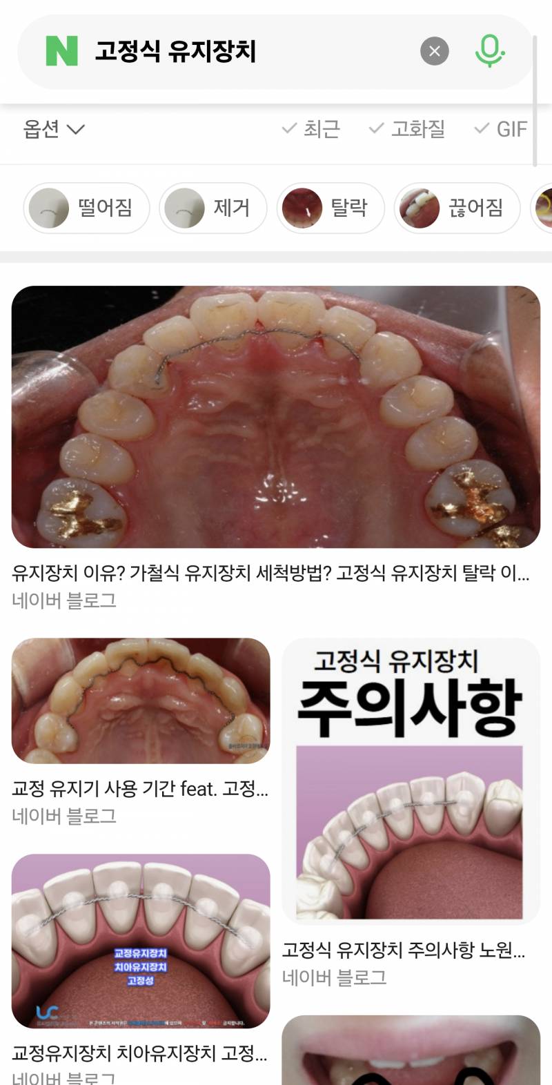 [잡담] 교정한 익들 이빨 뒤에 철사 유지장치 있잖아 그거 진짜 안불편해...? | 인스티즈
