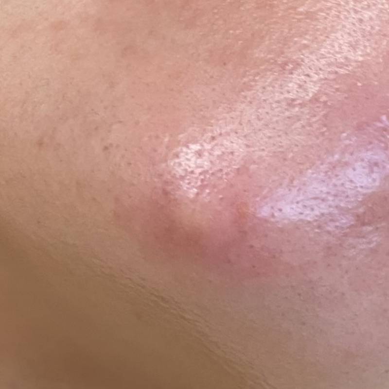 [잡담] 턱에난 왕여드름 개같이 기대중 | 인스티즈