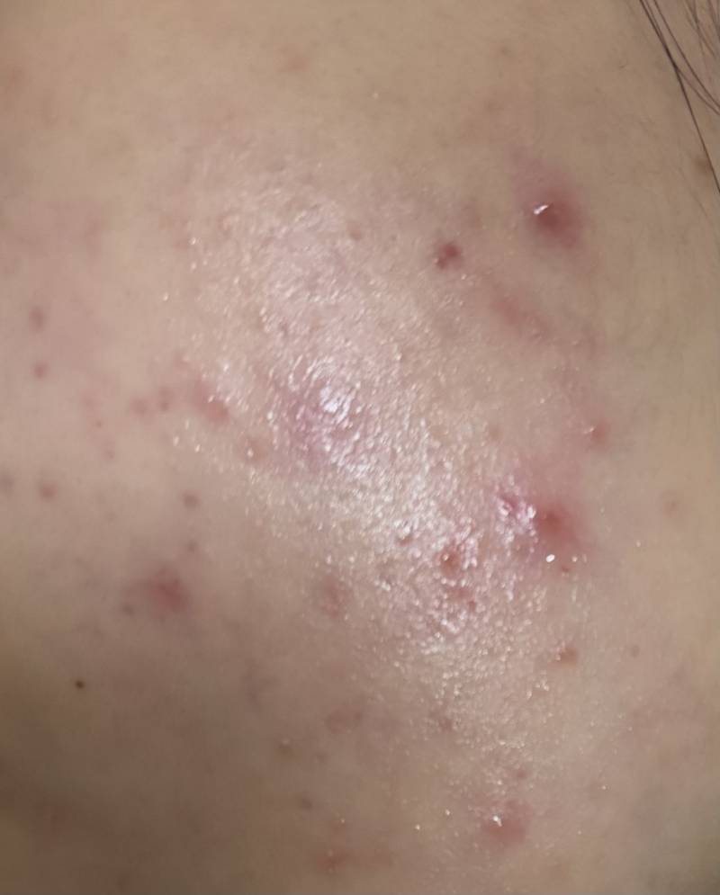 [잡담] (ㅎㅇㅈㅇ) 하루만에 볼에 여드름 파티 열렸는데 | 인스티즈