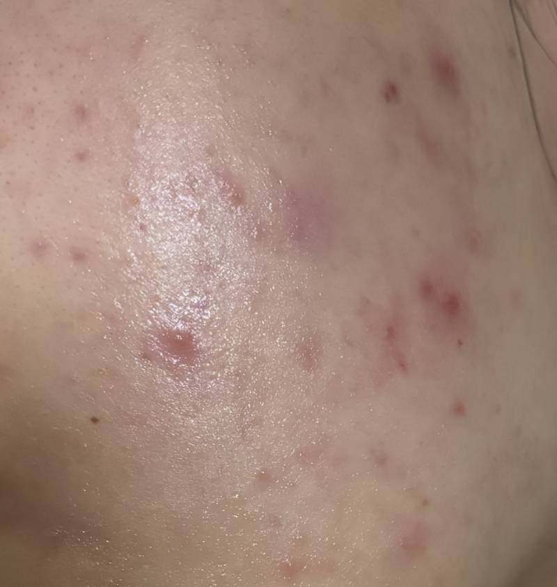 [잡담] (ㅎㅇㅈㅇ) 하루만에 볼에 여드름 파티 열렸는데 | 인스티즈