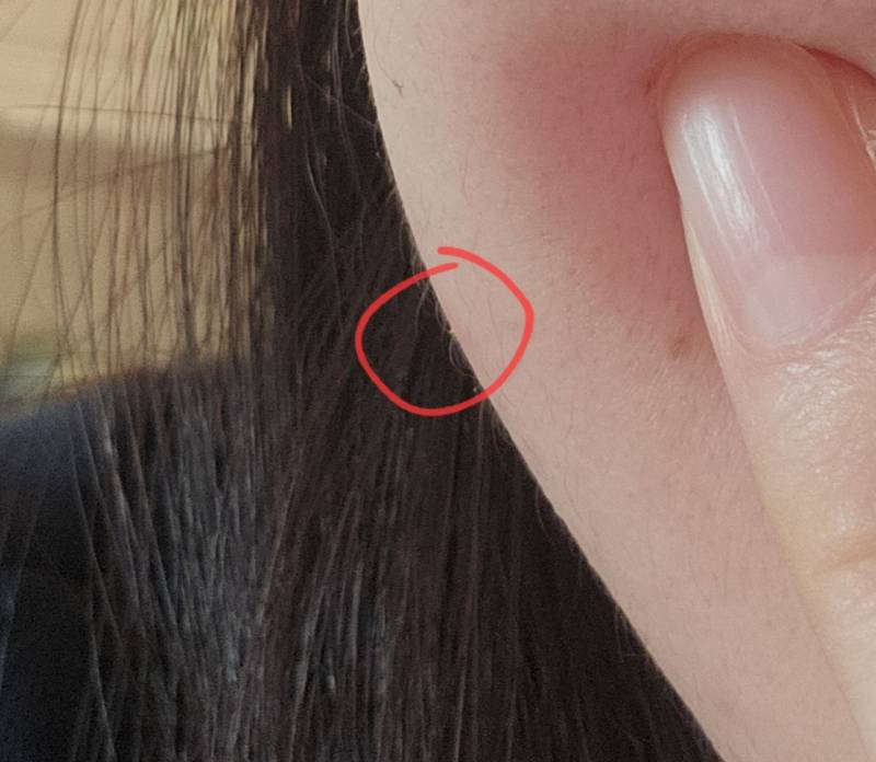 [잡담] 얼굴에 엄청 작은 가시 같은게 박혔는데 피부과 가면 될까? | 인스티즈