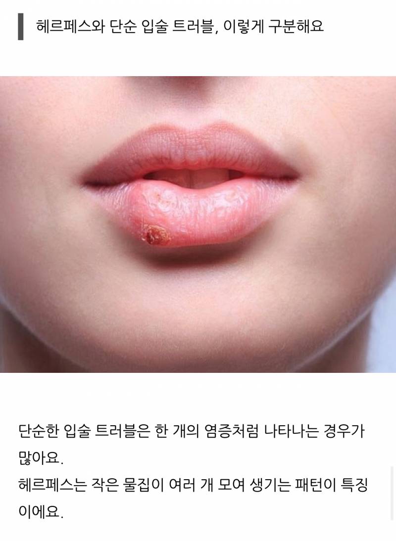 [잡담] ㅇ사진이랑 똑같으면 헤르페스는 아닌거야? | 인스티즈