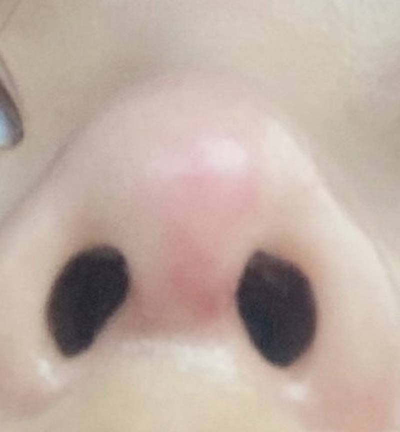 [잡담] 코성형했는데 이거 ㅈ망한거야…? | 인스티즈