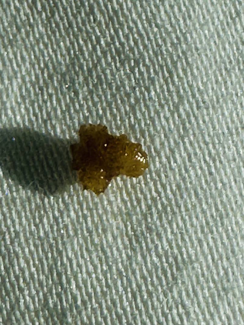 [잡담] 내 요도에서 나온 요로결석 볼 사람 ㅎㅇㅈㅇ | 인스티즈