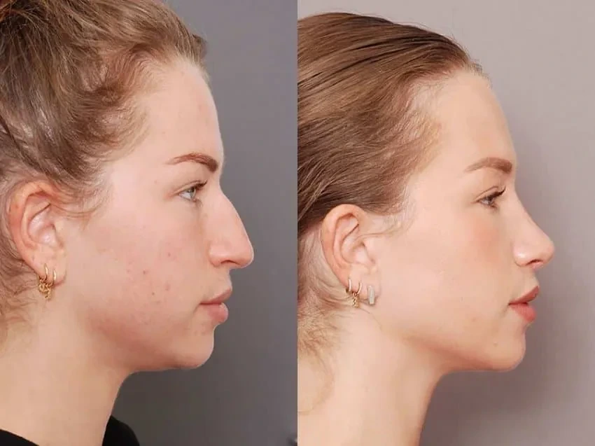 외국에서 많이 한다는 메부리코 수술.jpg | 인스티즈