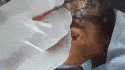 머리에 치료용구더기.GIF 미방있음 (혐오주의) | 인스티즈