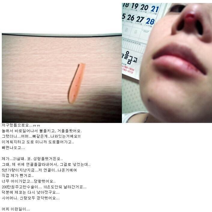 코성형수술 부작용 (혐오주의) | 인스티즈