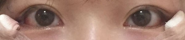 눈꼬리내리기뒤트임하고 인생 제대로 망할 뻔 했습니다.*혐오주의 | 인스티즈