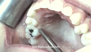 입천장 얼얼하게 해드림.gif (혐오주의) | 인스티즈