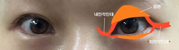 눈꼬리내리기뒤트임하고 인생 제대로 망할 뻔 했습니다.*혐오주의 | 인스티즈