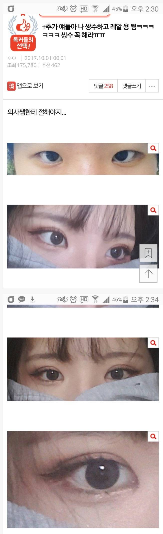 눈 성형의 위엄 | 인스티즈