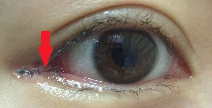 눈꼬리내리기뒤트임하고 인생 제대로 망할 뻔 했습니다.*혐오주의 | 인스티즈