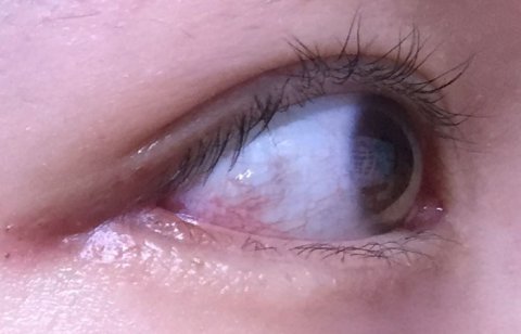 눈꼬리내리기뒤트임하고 인생 제대로 망할 뻔 했습니다.*혐오주의 | 인스티즈