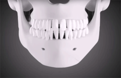 턱수술과 양악수술의 차이.gif | 인스티즈