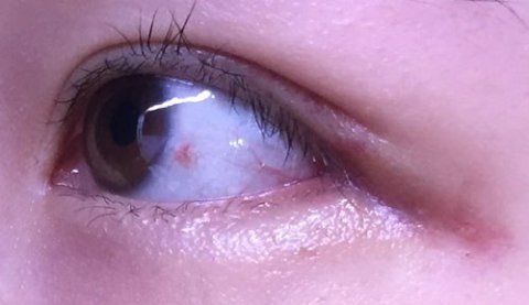 눈꼬리내리기뒤트임하고 인생 제대로 망할 뻔 했습니다.*혐오주의 | 인스티즈