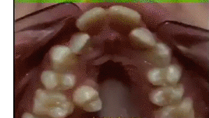신기한 치아교정 과정 | 인스티즈