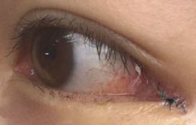 눈꼬리내리기뒤트임하고 인생 제대로 망할 뻔 했습니다.*혐오주의 | 인스티즈