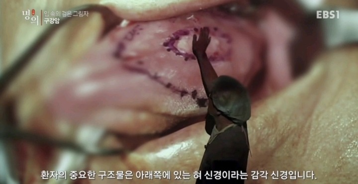 구강암 환자들은 혀를 잘라야한다는 사실에 큰 심리적 충격을 받는다.jpg | 인스티즈