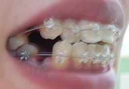 치아교정을 쉽게 생각해선 안되는 이유 (외모 변화) | 인스티즈