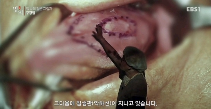 구강암 환자들은 혀를 잘라야한다는 사실에 큰 심리적 충격을 받는다.jpg | 인스티즈