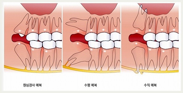 치과치료 고통 사랑니 발치 vs 신경치료 | 인스티즈